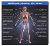 Lupus Autoimmune Disease Symptoms Images