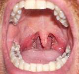 Images of Pharynx Symptoms Infection
