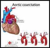 Pictures of Coarctation Of Aorta And Bicuspid Aortic Valve