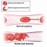Diagnosis Of Sickle Cell Anaemia Images