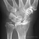 Photos of Arthritis In Wrists Symptoms
