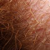 Images of Male Yeast Infection Symptoms