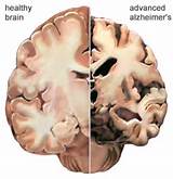 Images of Dementia Vs Alzheimer''s
