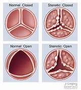 Stenosis Of The Aortic Valve Pictures
