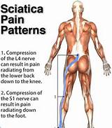 Images of Sciatica Tumor Symptoms