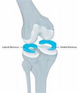 Images of Medial Meniscus Pain