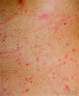 Images of Cancer Symptoms Itchy Skin