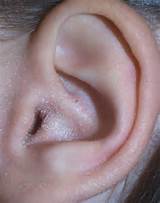 Toddler Ear Infection Symptoms Pictures
