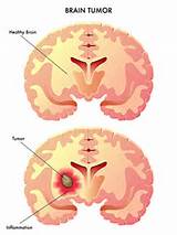 Pictures of Brain Tumors Stage 4
