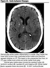 Photos of Ischemic Brain Disease