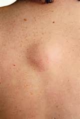 Pictures of Is A Lipoma A Tumor