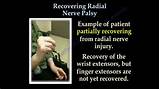 Youtube Radial Nerve Palsy Images