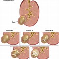 3 Cm Kidney Cyst