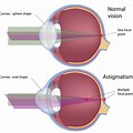 Astigmatism Dry-Eye