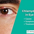 Chlamydia Eye Infection Symptoms
