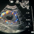 Corpus Luteum Ovary Ultrasound