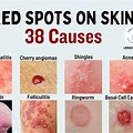 Dark Red Spots On Skin