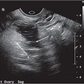 Dermoid Cyst Fetal Ultrasound
