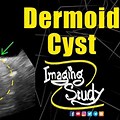 Dermoid Cyst Ultrasound Characteristics