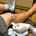 Draining Fluid After Knee Surgery