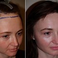 Female Hair Transplant Before After
