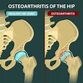 Hip-Joint Osteoarthritis