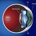 ICL Contact Lens