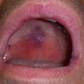 Kaposi Sarcoma in Oral Cavity