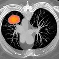 Lung Cancer CT Scan