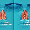 Nasal Septum Deviation