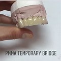 PMMA Fixed Bridge