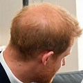 Prince Harry Hair Loss