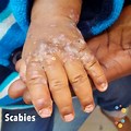 Scabies On Dark Skin