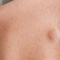 Sebaceous Cyst On Shoulder Blade