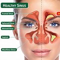 Sinus Infection Headache Symptoms