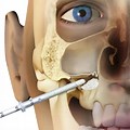Sinus Lift Dental Implant and Sinusitis