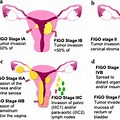 Stage 1A Endometrial Cancer