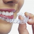 Teeth Straightening Aligners