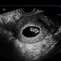 Transvaginal Ultrasound 7 Weeks Pregnant