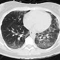Vaping Lungs CT Scan