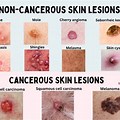 What Causes Skin Lesions