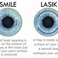What Is Smile Eye Surgery