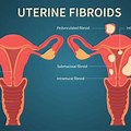 What Is a Fibroid Uterus