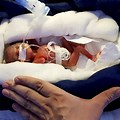 World Smallest Baby Ever Born