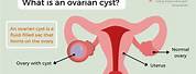 25 Cm Ovarian Cyst