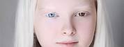 Albino Girl with Green Eyes