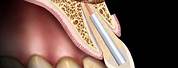 Apicoectomy Tooth 9