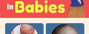 Baby Food Allergy Symptoms