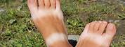 Bad Sunburn Feet