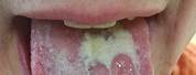 Chlamydia Tongue Symptoms